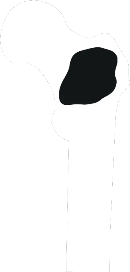 When Cancer Spreads To Clip Art Png Bone Transparent