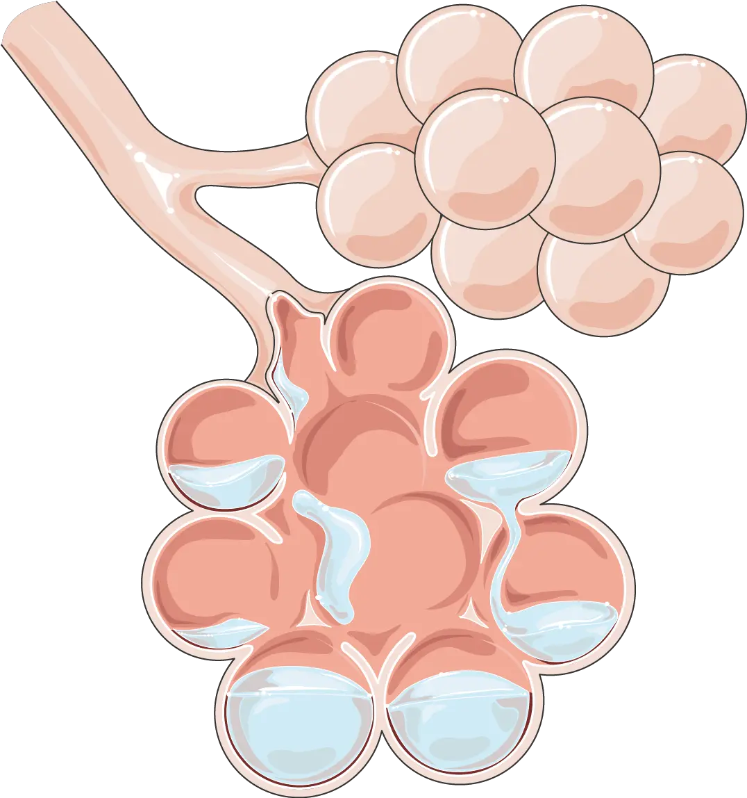 Pulmonary Edema Servier Medical Art Furosemide Works In Pulmonary Edema Png Lung Png