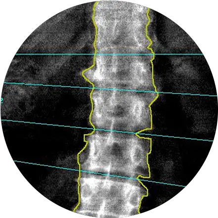 Bone Density Scan Radnet San Fernando Valley Bone Density Scan Png Bone Transparent