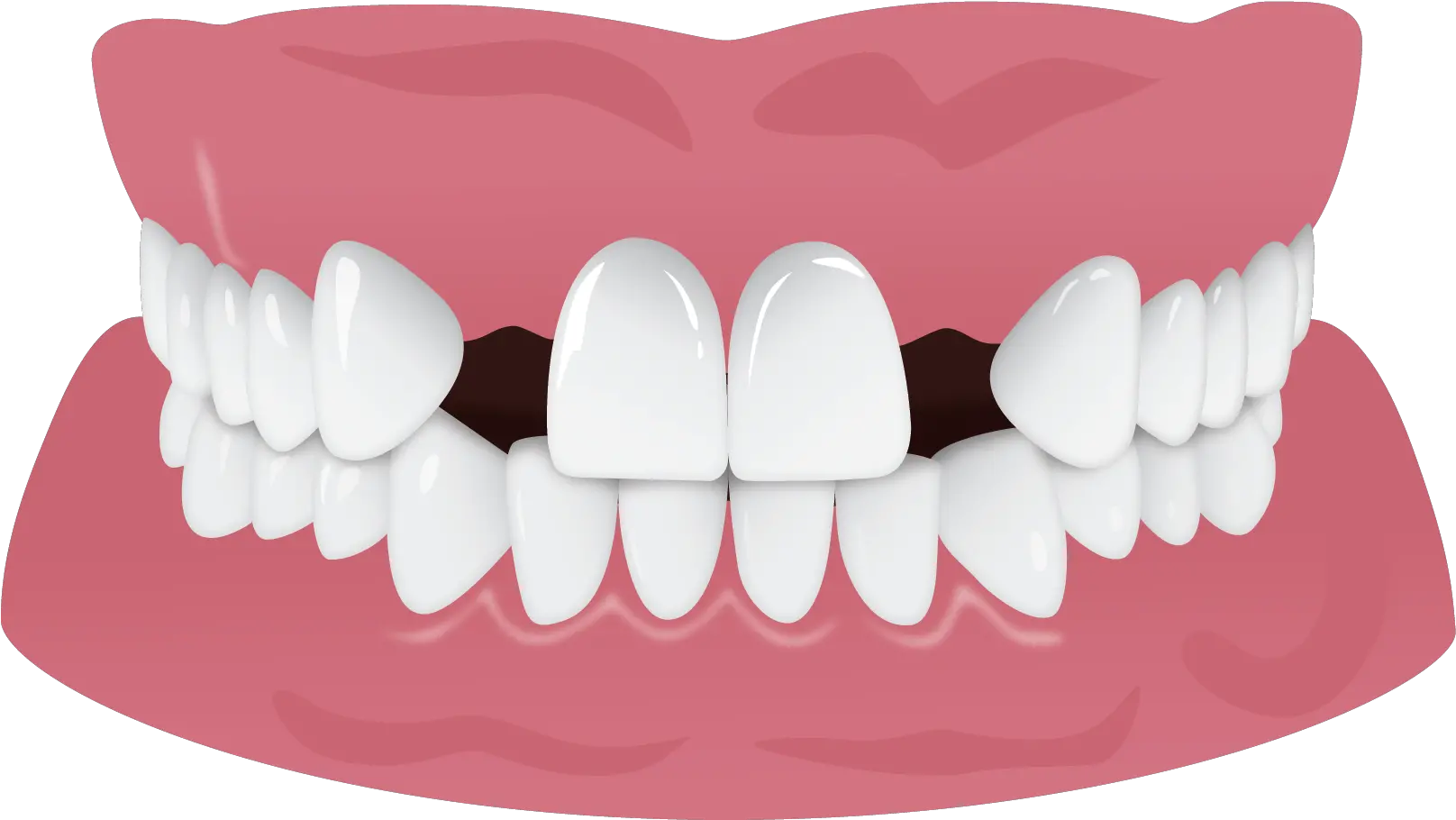 Teeth Smile Png Missing Teeth Cross Bite 1058195 Vippng Human Tooth Bite Png