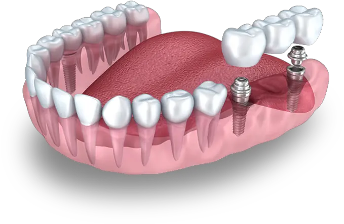 Q And M Home Dental Implant Missing Teeth Much It Cost A Dental Crown Png Teeth Png