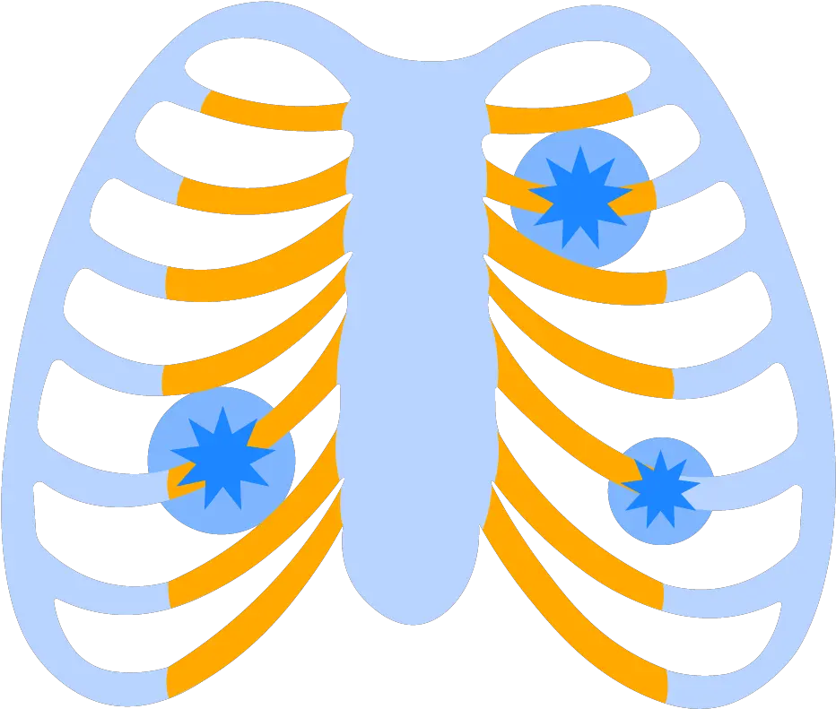 Acute Costochondritis Symptoms U0026 Treatment Of Chest Wall Pain Png Icon Pop Quiz Characters Level 7