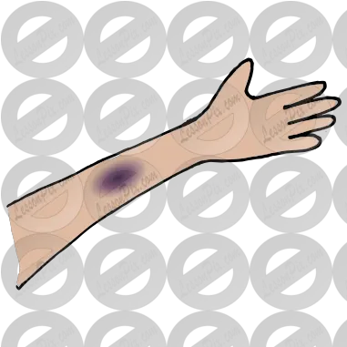 Bruise Picture For Classroom Therapy Hand Png Bruise Png