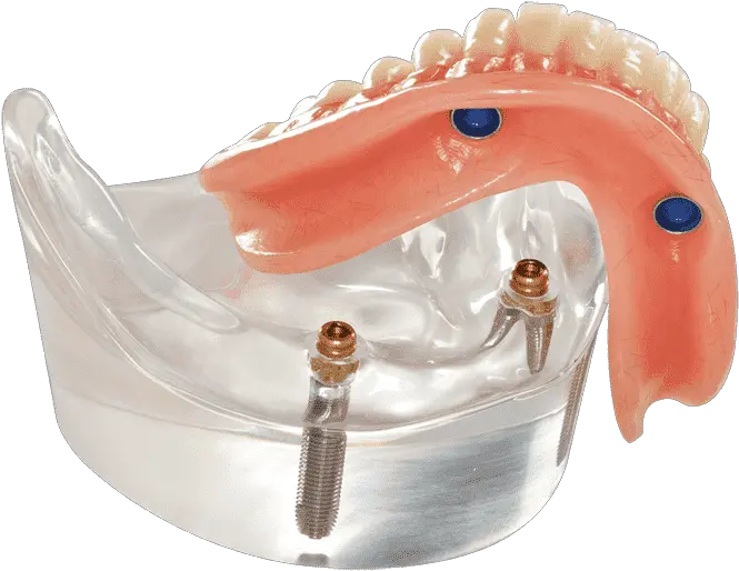 Implant Supported Overdenture U201citu0027s A Snapu201d Mydental Tampa Implant Supported Dentures Png Best Price On Jawbone Icon