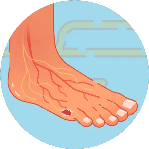 Prevent Diabetic Foot Ulcers And Avoid Amputation U2013 Home Ankle Png Foot Icon Vector