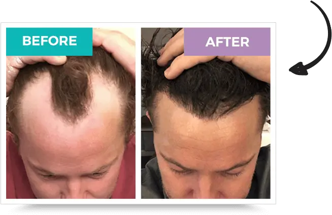 Hair Loss In Men And Women Could Stress Be The Cause Enm Long Does Hair Transplant Last Png Women Hair Png