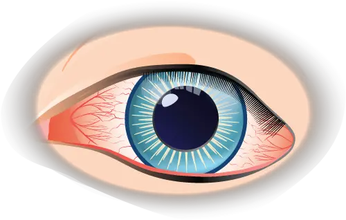 Conjunctivitis Eye Condition Treatment Dry Png Eye Wash Icon
