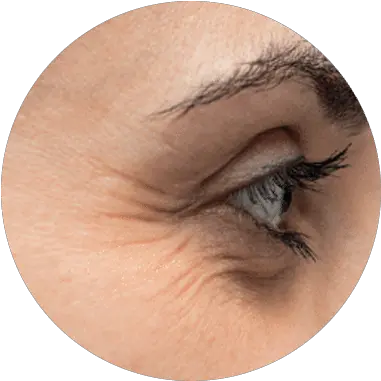 Eye Rim Treatment Hyamatrixnl Vitamin D Deficiency Skin Face Png Crying Eyes Png