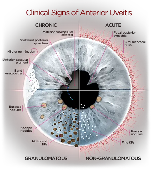 Anterioruveitisdiagrampng 500558 Uveitis Eye Facts Clinical Signs Of Uveitis Human Eyes Png