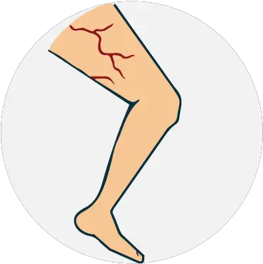 Download Hd Varicose Vein Illustration Transparent Png Clip Art Vein Png