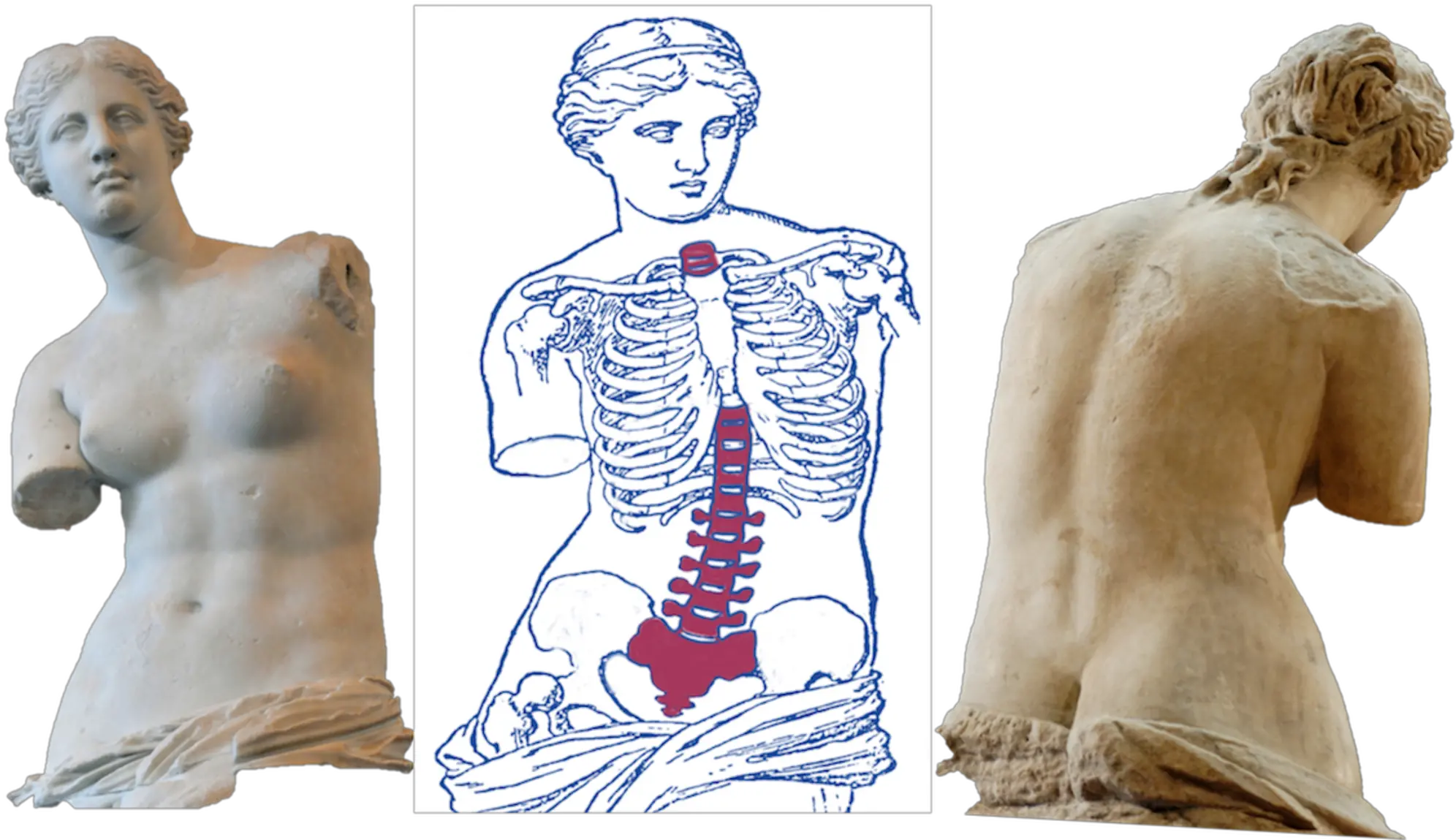 Cureus Does The Venus De Milo Have A Spinal Deformity Venus De Milo With Arms Png Venus Transparent