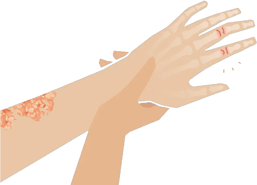 Psoriatic Arthritis Clinlife Sign Language Png Pointing At You Icon