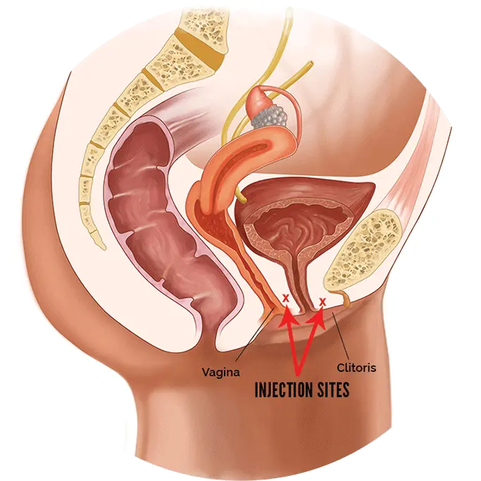 Lady Spot Shot Tampon In Vagina Diagram Png Vagina Png